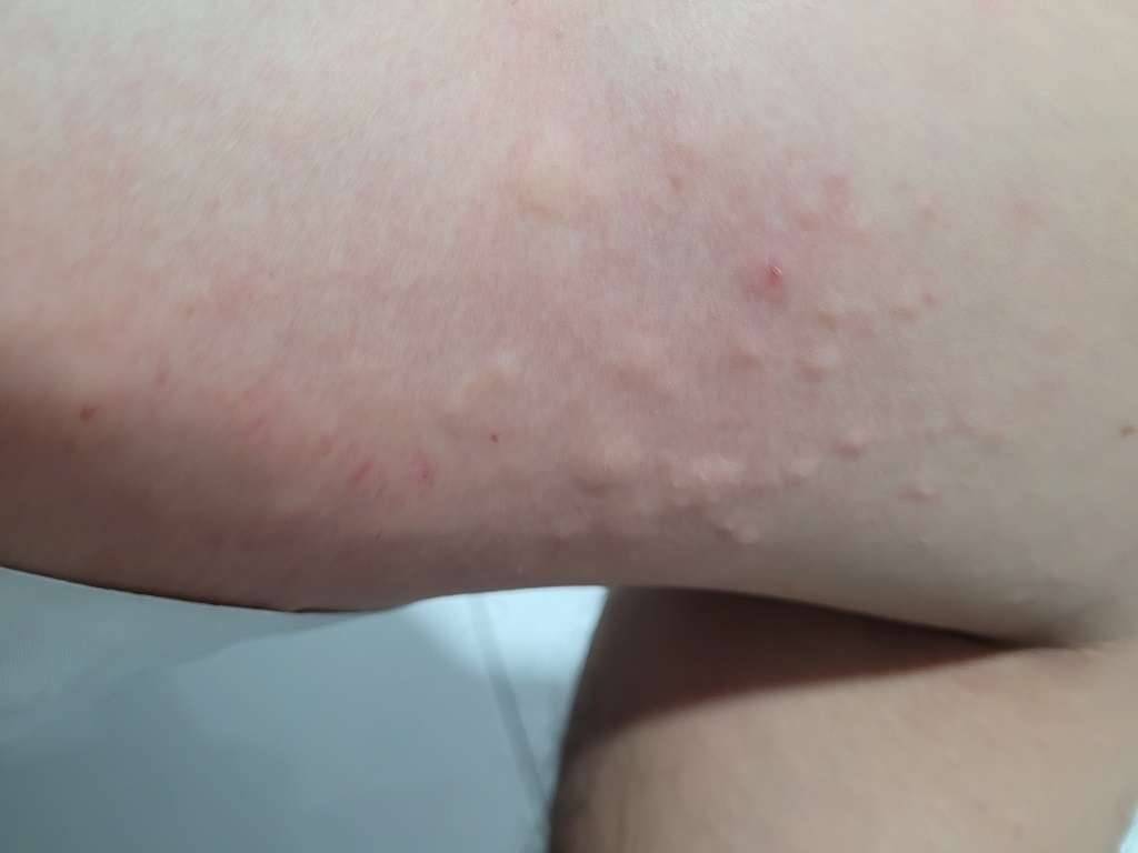 Welts from unknown bites